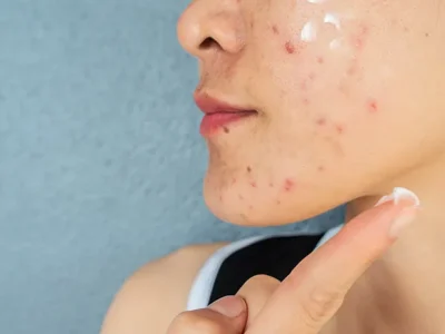 Skincare Guna Menghilangkan Bekas Jerawat