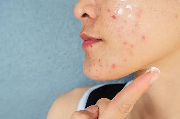 Skincare Guna Menghilangkan Bekas Jerawat