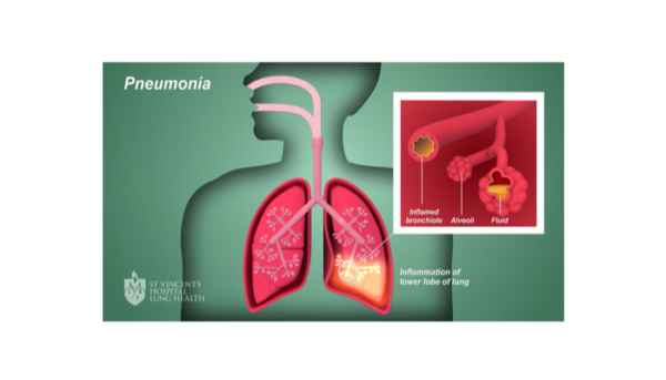 Penyakit Pneumonia Penyebab Kematian Terbesar Pada Anak