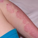 Penyakit Psoriasis