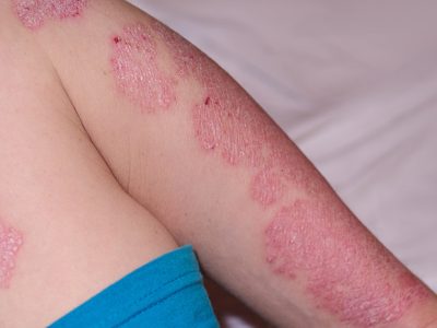 Penyakit Psoriasis