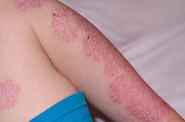 Penyakit Psoriasis Autoimun Kronis Akibat Tumbuh Sel Kulit Cepat