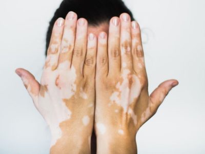 Penyakit Vitiligo